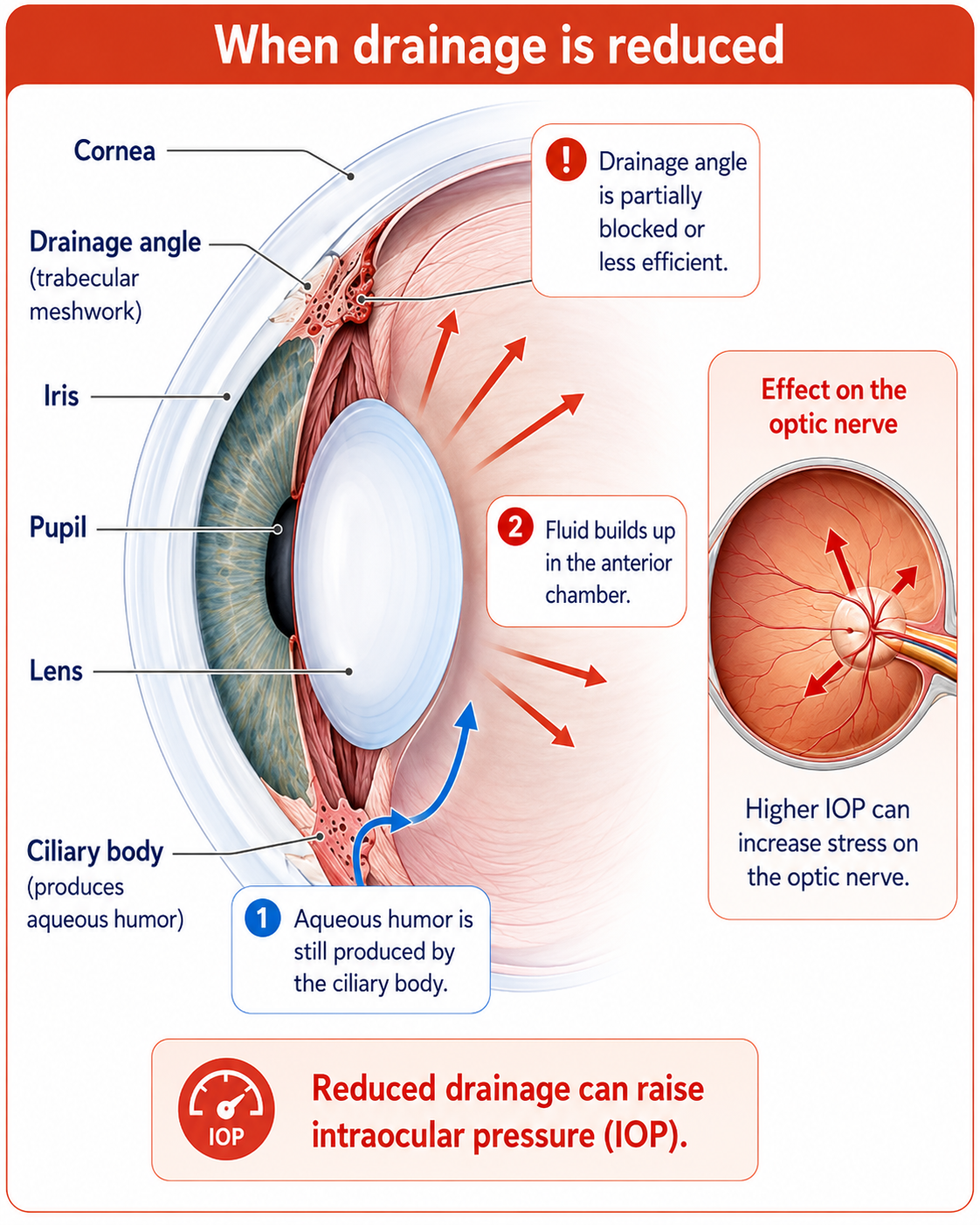 Illustration showing reduced aqueous humor drainage causing fluid buildup, increased intraocular pressure and increased stress on the optic nerve.